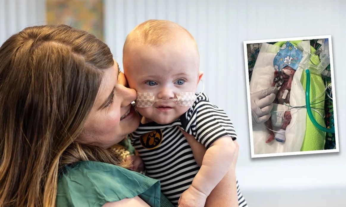 Το πρόωρο μωρό που ζύγιζε 283 γραμμάρια όταν γεννήθηκε, έγινε ενός έτους και μπήκε στο βιβλίο Γκίνες