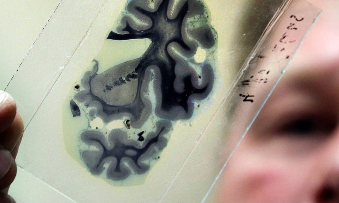 Υγιεινές καθημερινές συνήθειες μειώνουν τον κίνδυνο εμφάνισης Αλτσχάιμερ