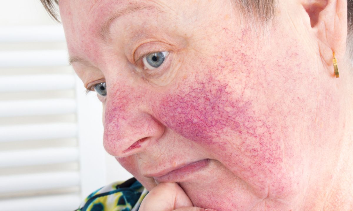 Ροδόχρους ακμή: Αιτίες και συμπτώματα της ακμής των ενηλίκων (εικόνες)