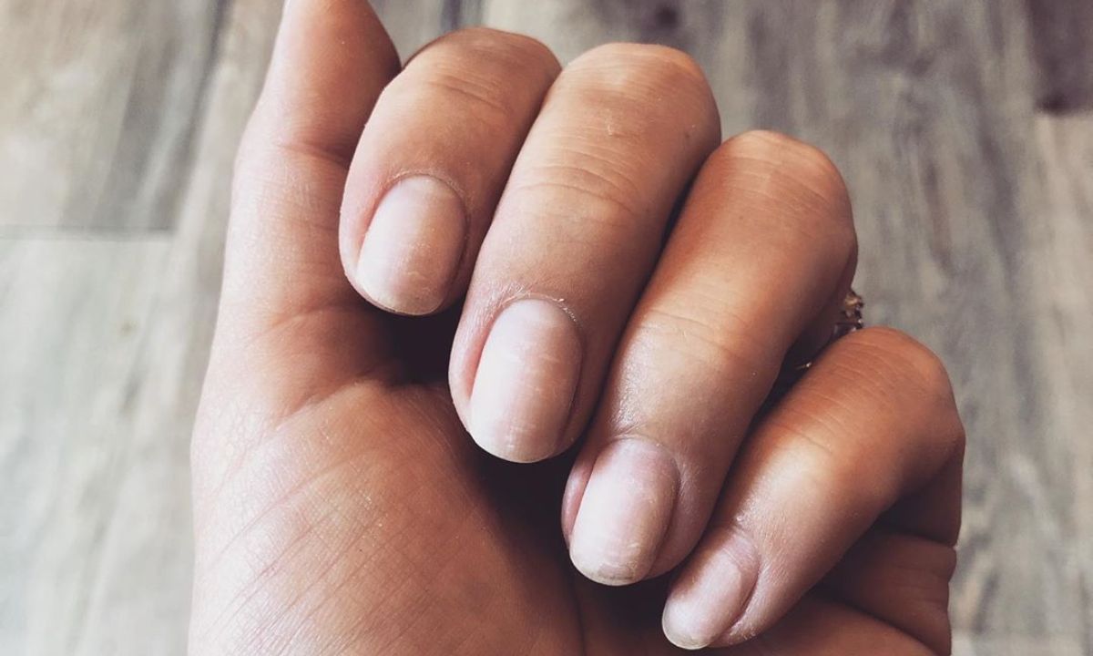 Έχεις λευκά σημάδια στα νύχια σου; Μάθε τι πρέπει να κάνεις