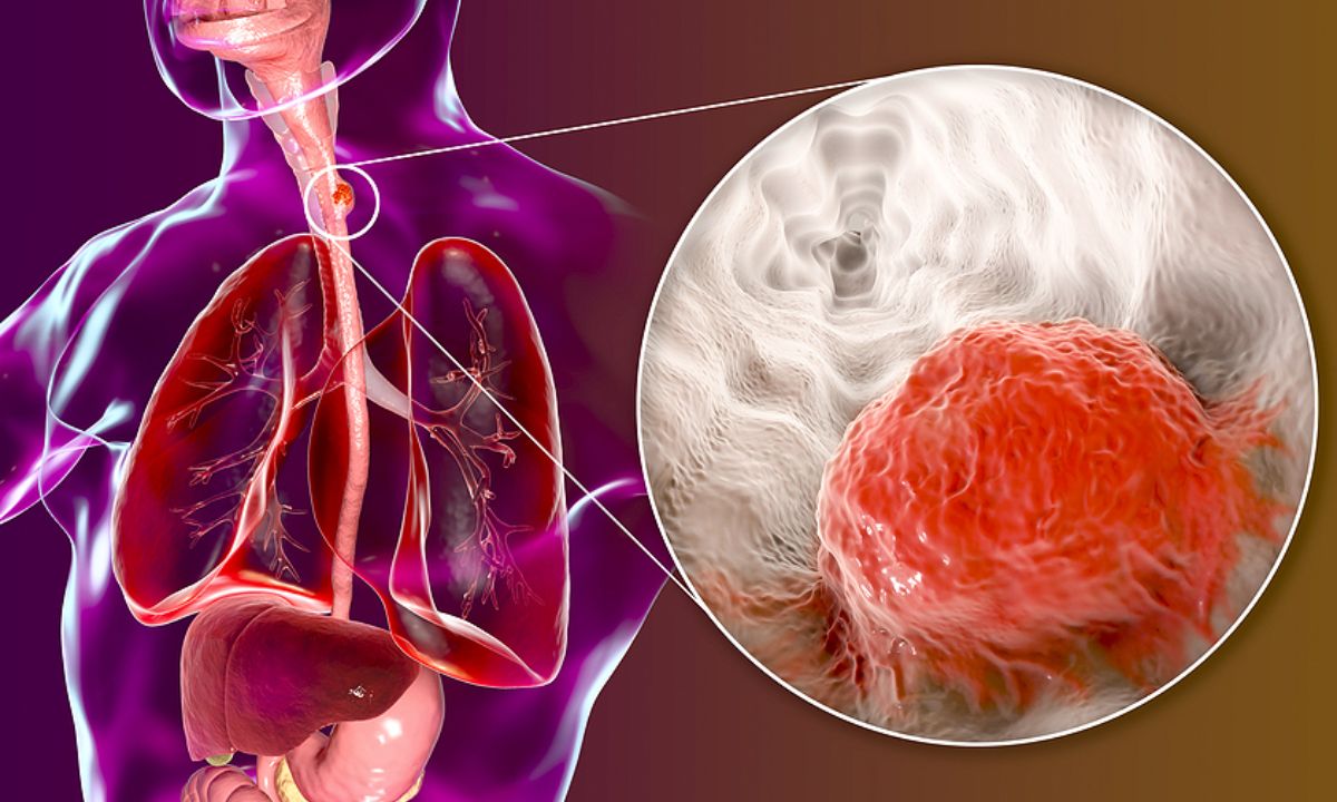 Καρκίνος οισοφάγου: Πώς θα μειώσετε τον κίνδυνο (εικόνες)