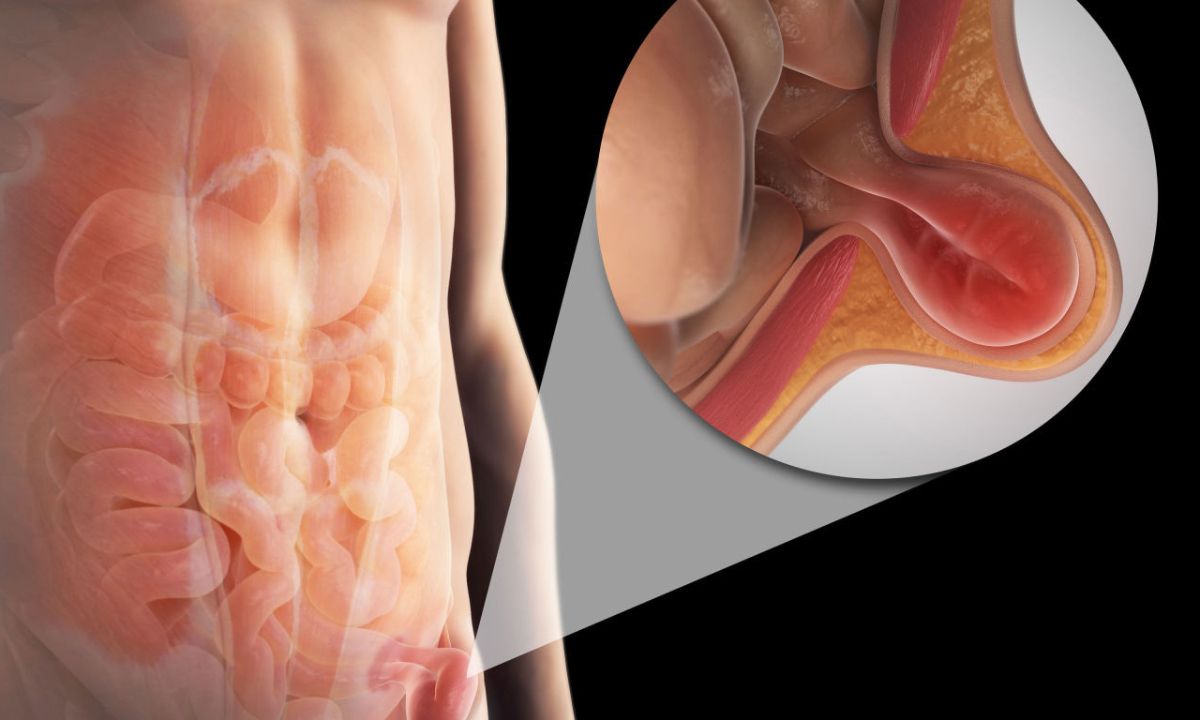 Κήλη: Πρόληψη και αντιμετώπιση (εικόνες)