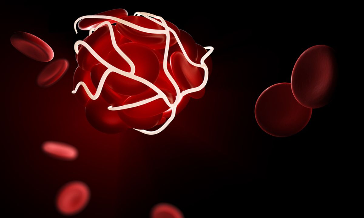 Θρόμβος στο αίμα: 7 σιωπηλά σημάδια που πρέπει να γνωρίζετε (εικόνες)