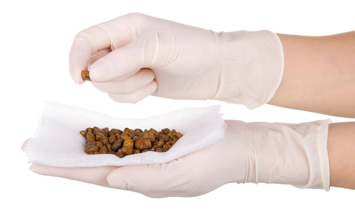 Ο τροφές που σας προστατεύουν από τον σχηματισμό λίθων στη χολή (εικόνες)