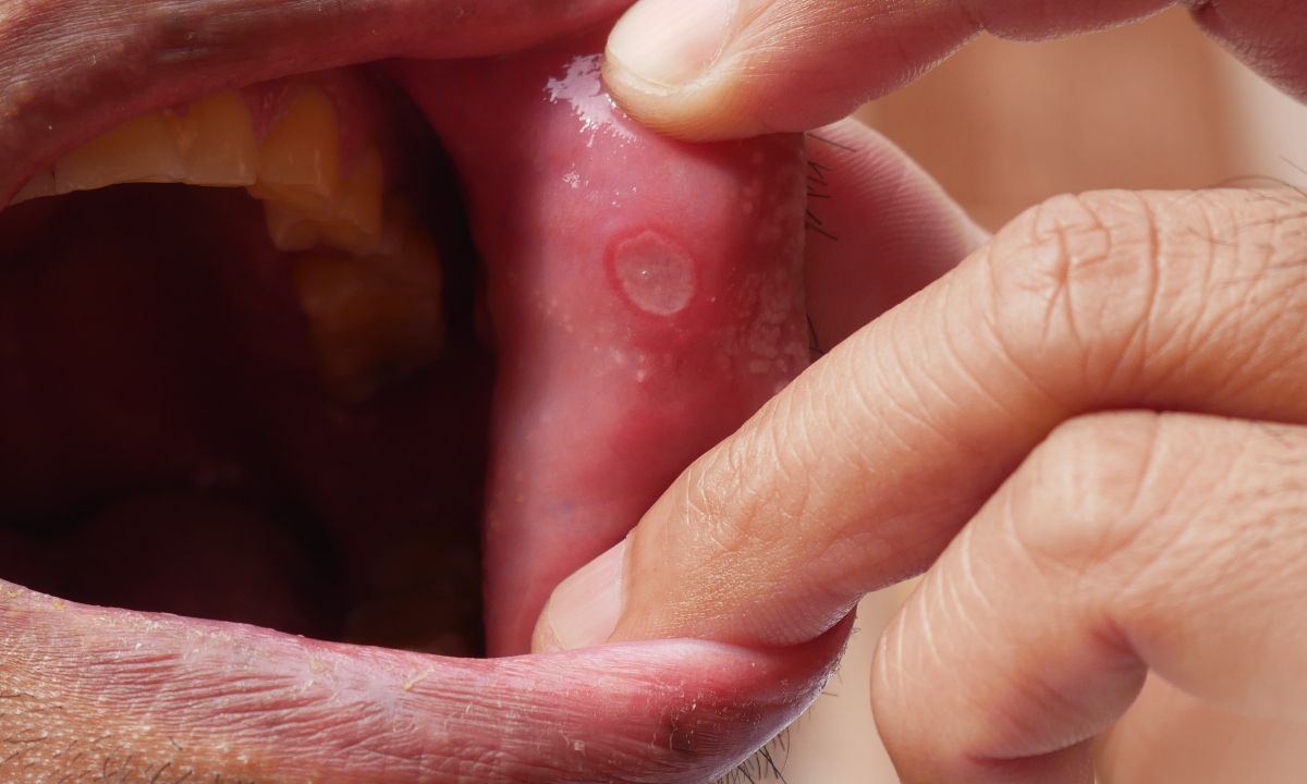 Έλκη στο στόμα: Πού μπορεί να οφείλονται (εικόνες)