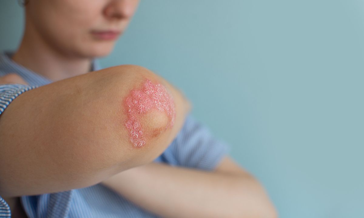 Ψωριασική αρθρίτιδα: Οι παράγοντες που αυξάνουν τον κίνδυνο (εικόνες)