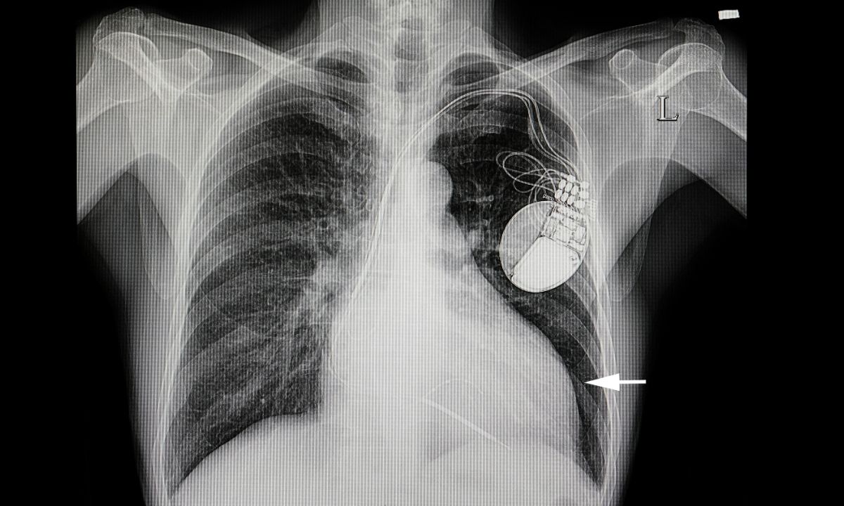 Υγρό στον πνεύμονα: Ποια είναι τα ένοχα συμπτώματα (εικόνες)