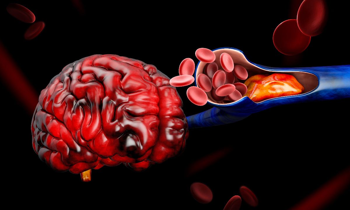 Αρτηριακή θρόμβωση: Για ποιους καρκίνους αυξάνει τον κίνδυνο (εικόνες)