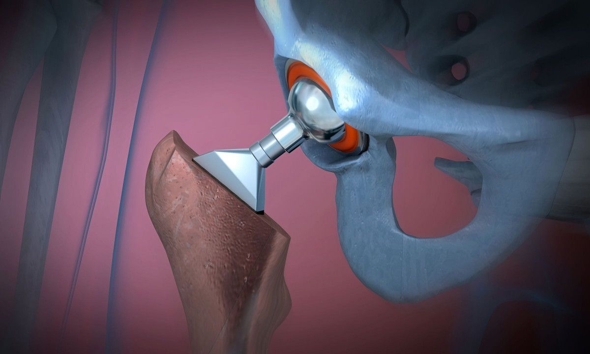 Μετεμμηνόπαυση και κάταγμα ισχίου: Οι βιταμίνες που αυξάνουν τον κίνδυνο