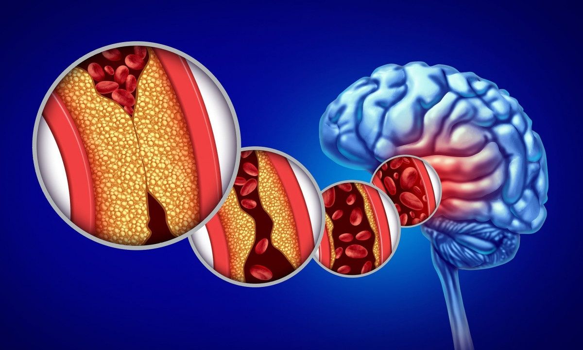 Χοληστερίνη: Γιατί δεν βλάπτει μόνο την καρδιά, αλλά και τον εγκέφαλο