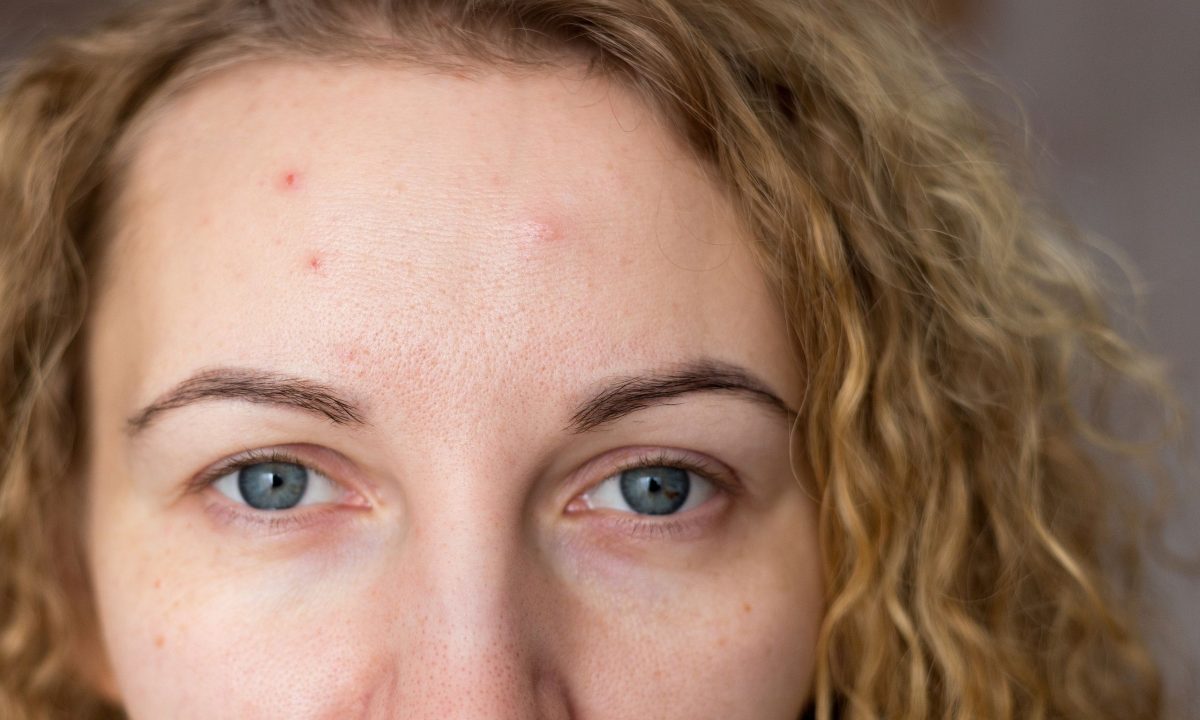 Ακμή ενηλίκων: 7 αιτίες που δεν γνωρίζετε και τρόποι αντιμετώπισης