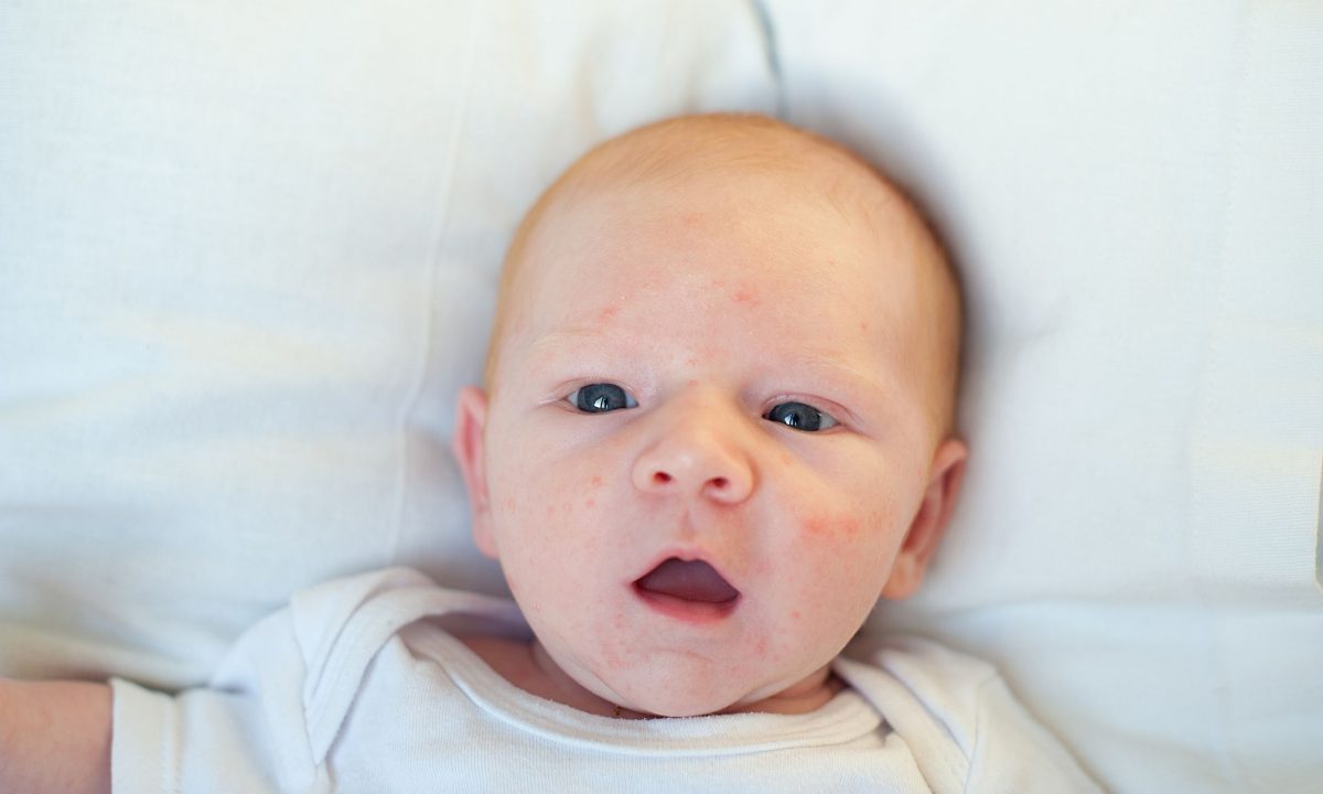 Ναι, η βρεφική ακμή είναι υπαρκτή - και πιο συνηθισμένη από όσο νομίζετε