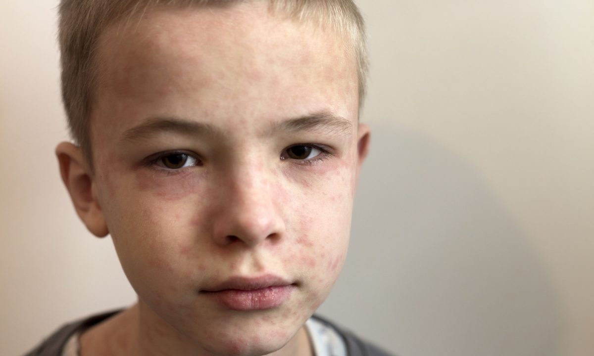 Ιλαρά: Οδηγός πρόληψης για γονείς