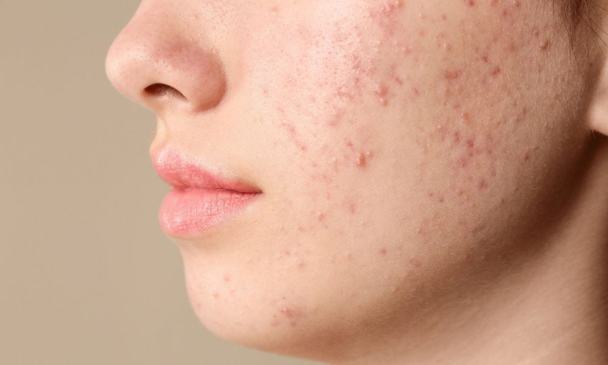 Καλοκαιρινή έξαρση ακμής σε έφηβους: Αιτίες και πρακτικές λύσεις