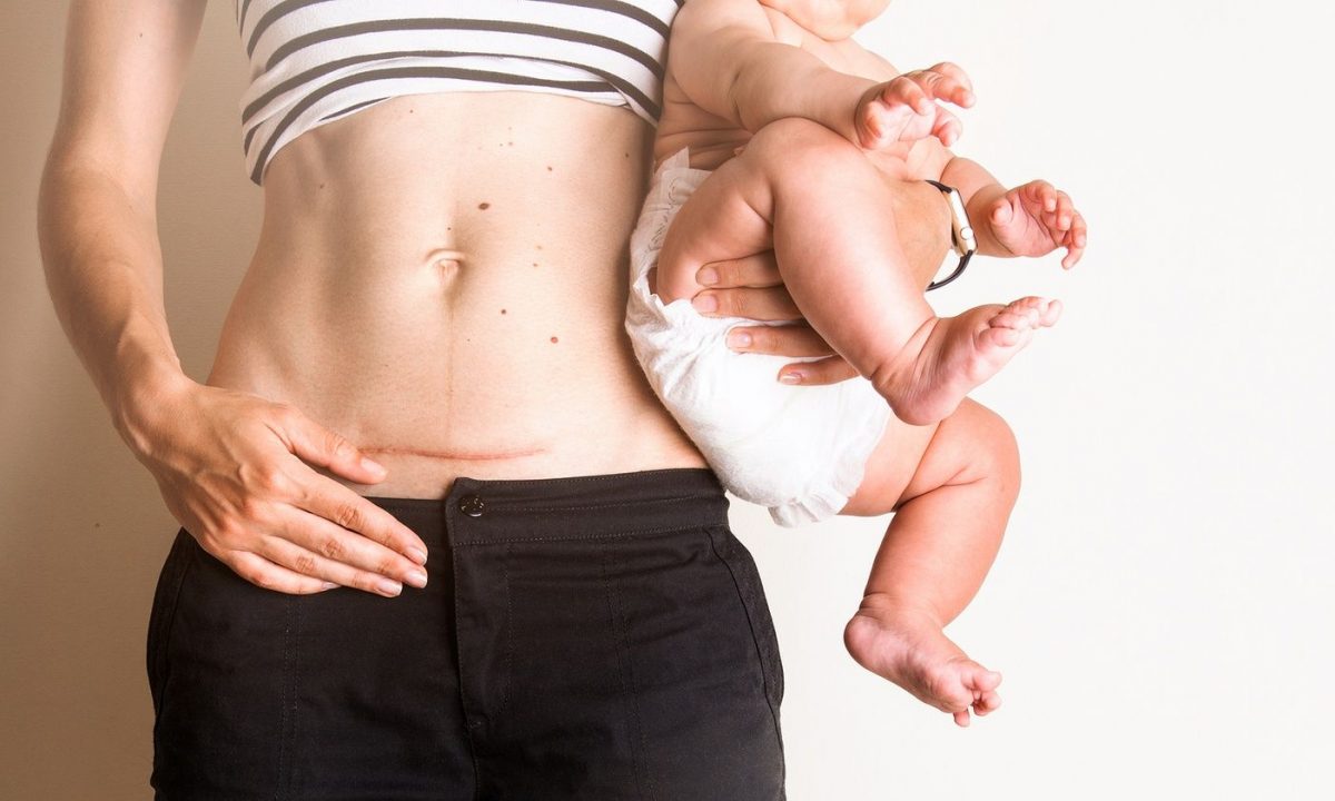 Τι πραγματικά συμβαίνει κατά τη διάρκεια μιας καισαρικής τομής – και πόση ώρα διαρκεί