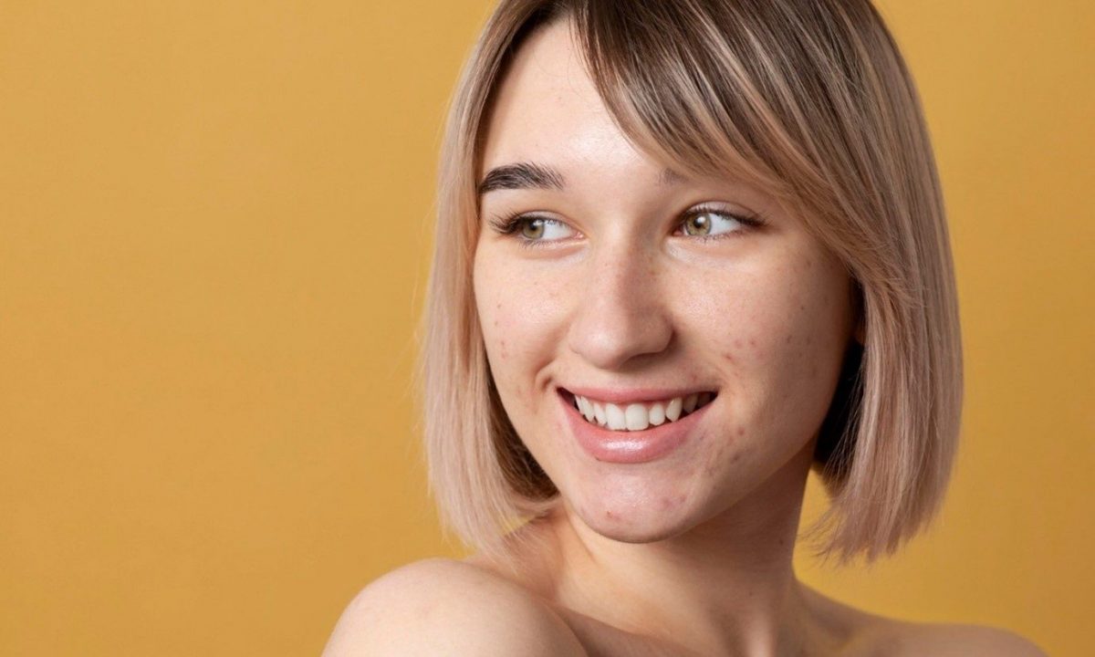 Ακμή στο πρόσωπο: Η ολοκληρωμένη ρουτίνα για καθαρή και λεία επιδερμίδα