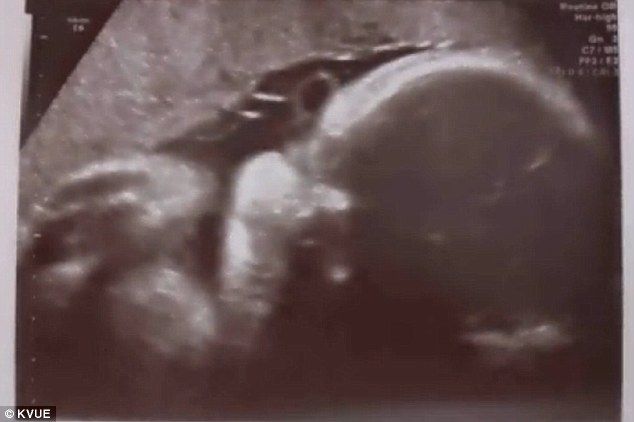 Αγώνας για να σωθεί έγκυος στην οποία διαγνώστηκε προχωρημένος καρκίνος του μαστού