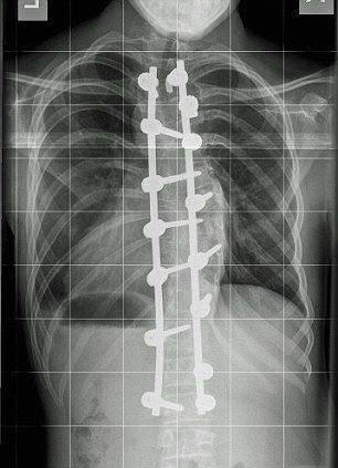 Έφηβος ψηλώνει κάθε βράδυ περίπου δύο πόντους μετά από εγχείρηση σκολίωσης!