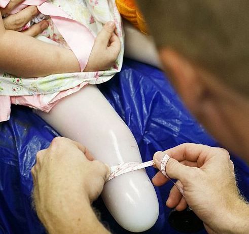 Απίστευτη ιστορία: Δίχρονη ξαναπερπάτησε μετά από ακρωτηριασμό που της προκάλεσε ο πατέρας της κατά λάθος!