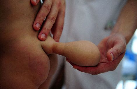 Συγκλονιστική ιστορία: Ουρά δέκα εκατοστών αναπτύσσει αγοράκι επτά μηνών στην μέση του! (Φωτογραφίες)