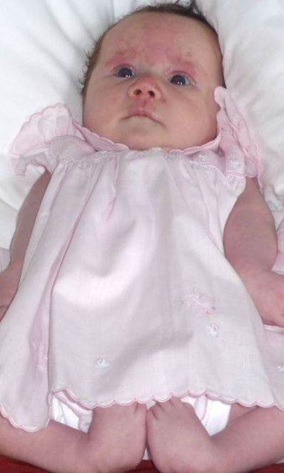 Το 5 χρονο κορίτσι που γεννήθηκε με πόδια βατράχου, έκανε τα πρώτα του βήματα!