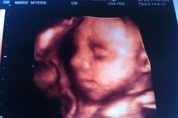 Έμεινε έγκυος από τον ετοιμοθάνατο άντρα της αλλά πέθανε πριν δει την κόρη του