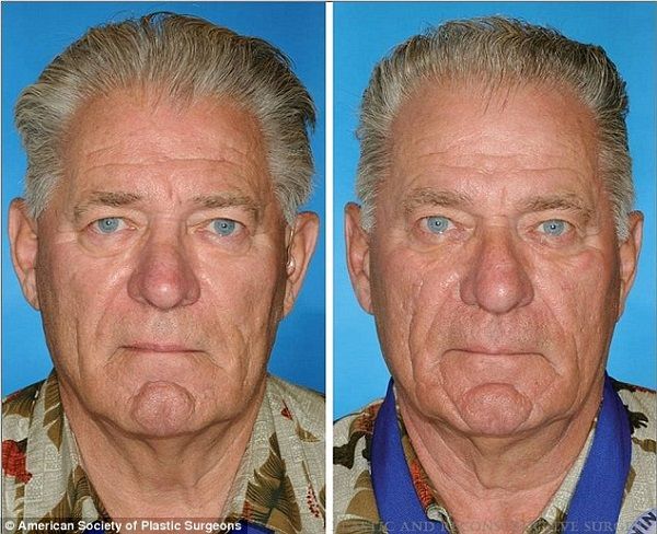 Δείτε τις επιπτώσεις του καπνίσματος σε φωτογραφίες πανομοιότυπων διδύμων