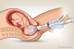 Πώς ένας μηχανικός αυτοκινήτων εφηύρε ένα νέο επικουρικό εργαλείο τοκετού (φωτογραφίες)