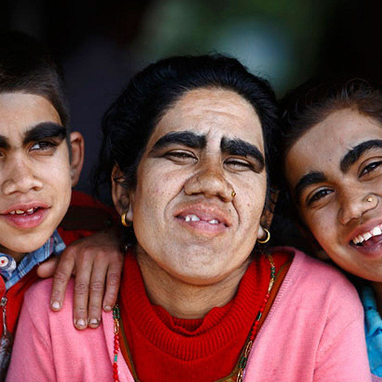 Οικογένεια «λυκανθρώπων» από το Νεπάλ μεταμορφώνεται, κάνοντας λέιζερ για την αφαίρεση τριχοφυίας