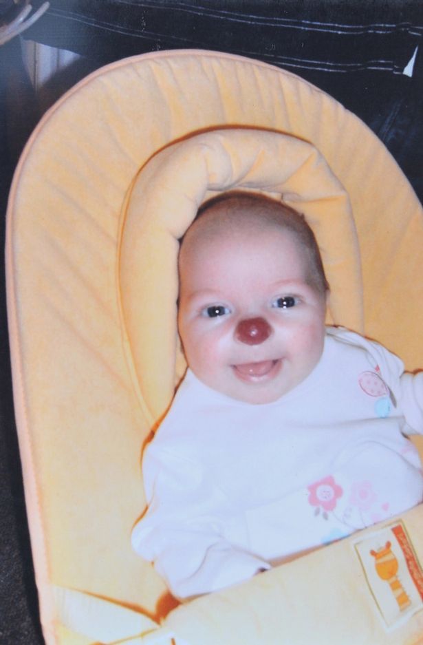 Κοριτσάκι γεννήθηκε με κόκκινη μυτούλα, όπως ο Ρούντολφ το ελαφάκι! (φωτογραφία)