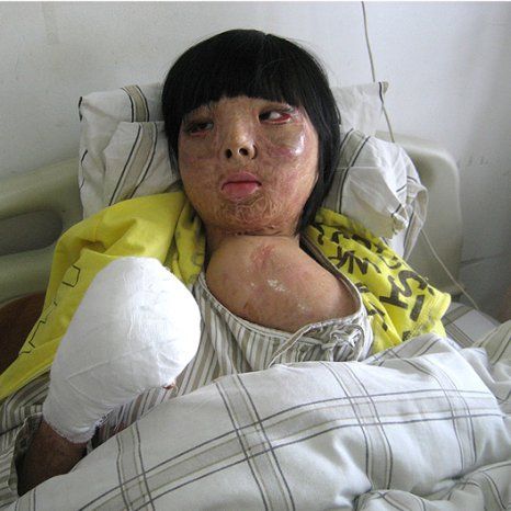 Δεκαεφτάχρονο κορίτσι υπέστη σοβαρά εγκαύματα και επανεμφύτευσε νέο πρόσωπο στο… στήθος της! (φωτογραφίες)