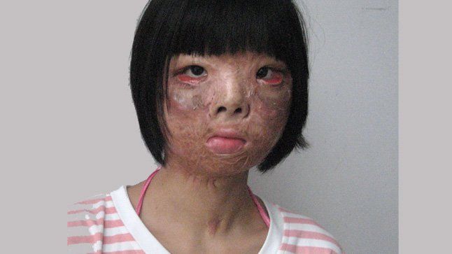 Δεκαεφτάχρονο κορίτσι υπέστη σοβαρά εγκαύματα και επανεμφύτευσε νέο πρόσωπο στο… στήθος της! (φωτογραφίες)