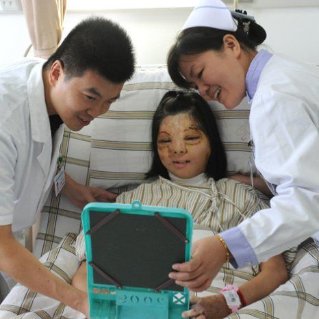 Δεκαεφτάχρονο κορίτσι υπέστη σοβαρά εγκαύματα και επανεμφύτευσε νέο πρόσωπο στο… στήθος της! (φωτογραφίες)