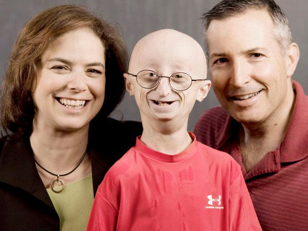 Εφυγε από τη ζωή 17χρονος Σαμ Μπερνς που έπασχε από προγηρία (εικόνες+βίντεο)