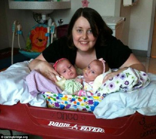 Η φυσιολογική ζωή των δίδυμων σιαμαίων κοριτσιών που χωρίστηκαν επιτυχώς!(βίντεο, εικόνες)