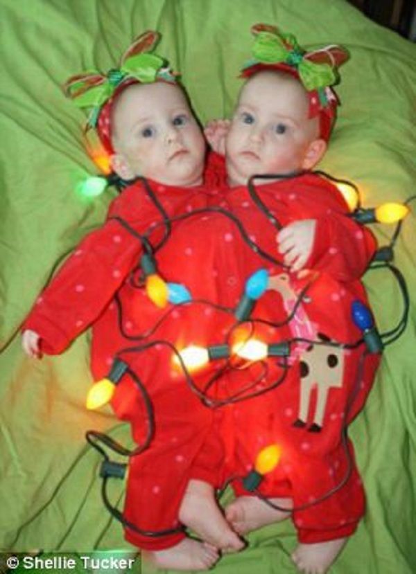 Η φυσιολογική ζωή των δίδυμων σιαμαίων κοριτσιών που χωρίστηκαν επιτυχώς!(βίντεο, εικόνες)