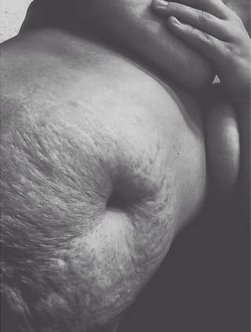 «Αγαπήστε τα σημάδια της εγκυμοσύνης σας»! Μία αλλιώτικη ομάδα με 25000 followers!