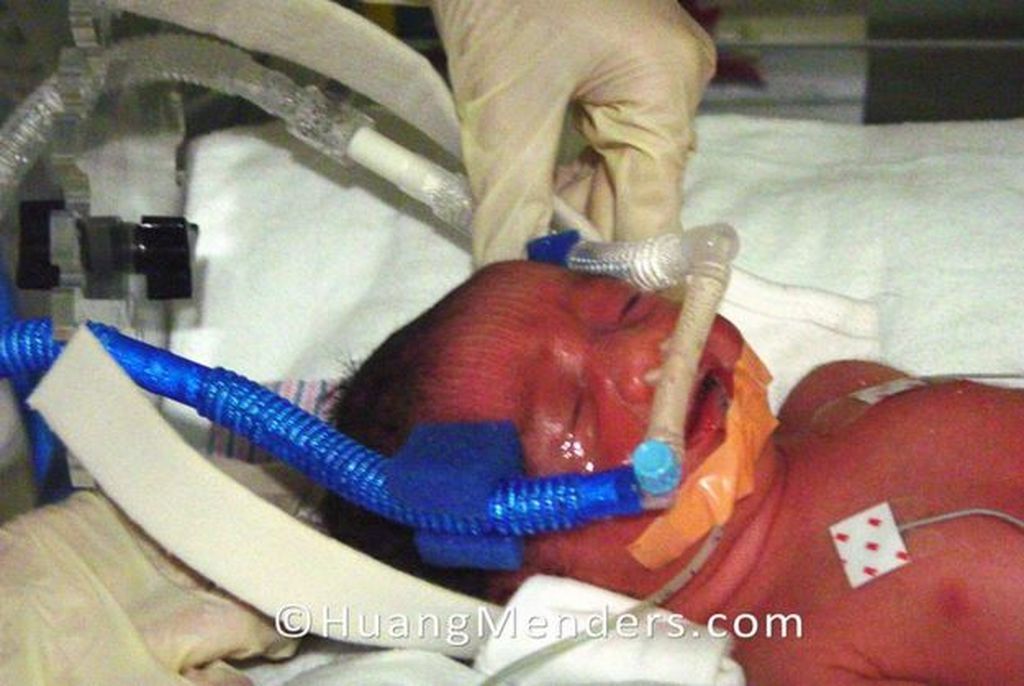 1. Η Ταλια γεννήθηκε  επτά εβδομάδες νωρίτερα