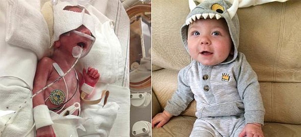 Ο Jesse γεννήθηκε στην 25η εβδομάδα. Όταν τραβήχτηκε η φωτογραφία ήταν 9 μηνών