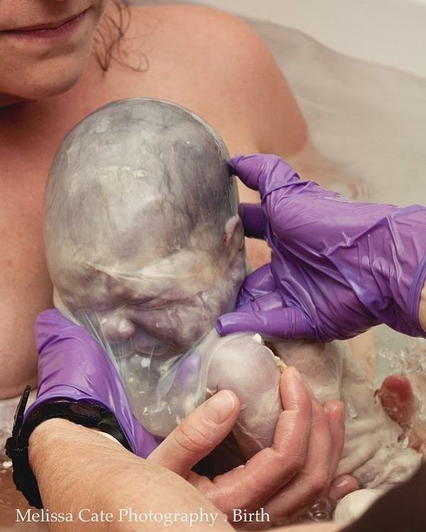 Εn-caul γέννηση ή αλλιώς γέννηση σε αμνιακό σάκο - Ένα εξαιρετικά σπάνιο φαινόμενο