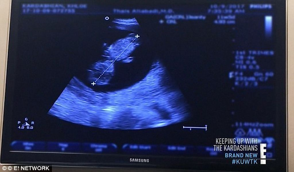 Khloe Kardashian: Αποκάλυψε ότι πρόκειται να φάει τον πλακούντα της