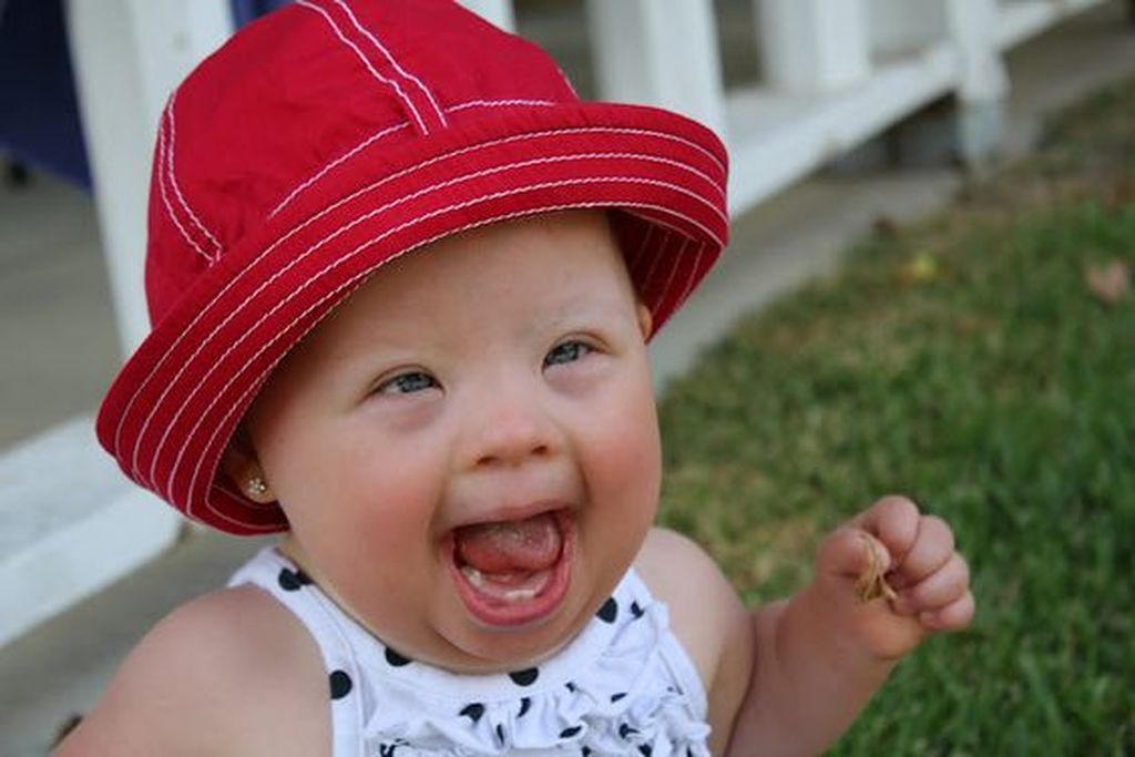 Ξεχωριστές φωτογραφίες μωρών με Σύνδρομο Down
