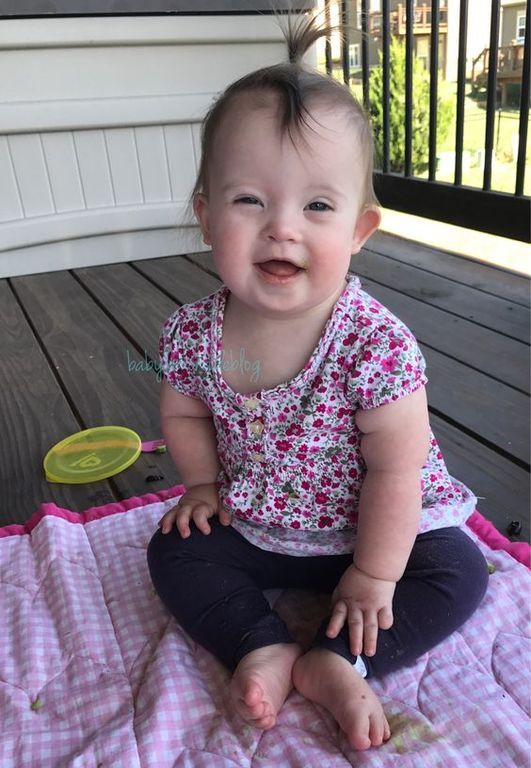 Ξεχωριστές φωτογραφίες μωρών με Σύνδρομο Down