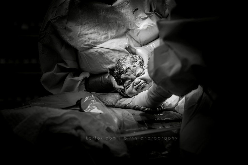 Καισαρική τομή: Τα πρόσωπα των μαμάδων σε αυτές τις φωτογραφίες μιλούν από μόνα τους