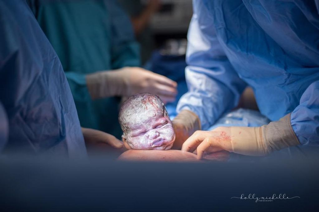 Καισαρική τομή: Τα πρόσωπα των μαμάδων σε αυτές τις φωτογραφίες μιλούν από μόνα τους