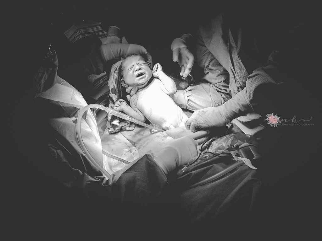 Καισαρική τομή: Τα πρόσωπα των μαμάδων σε αυτές τις φωτογραφίες μιλούν από μόνα τους