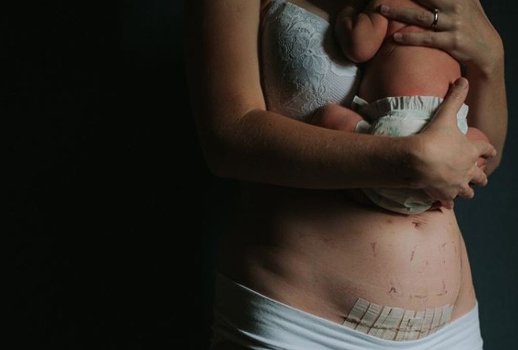 Σώμα μετά τη γέννα: Δεν θα ντραπείς ποτέ ξανά να δείξεις το κορμί σου, μόλις δεις αυτές τις μαμάδες