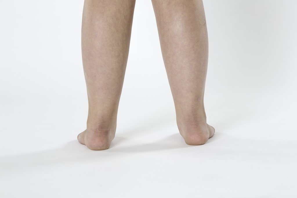 Πλατυποδία στα παιδιά και θεραπεία