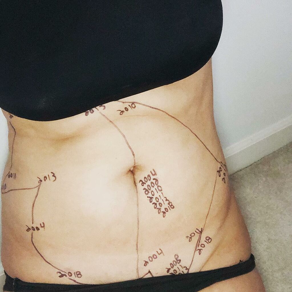 Γυναίκες δείχνουν πώς μοιάζει η ενδομητρίωση μέσα από τα σημάδια τους (pics)