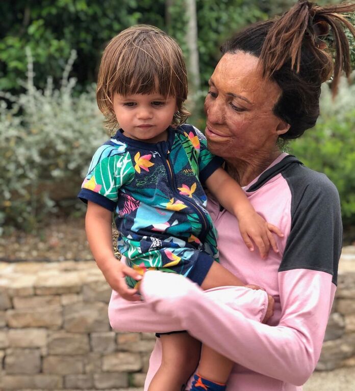 Θυμάστε την Turia Pitt που επέζησε από μια καταστροφική πυρκαγιά; Είναι έγκυος για 2η φορά (pics)